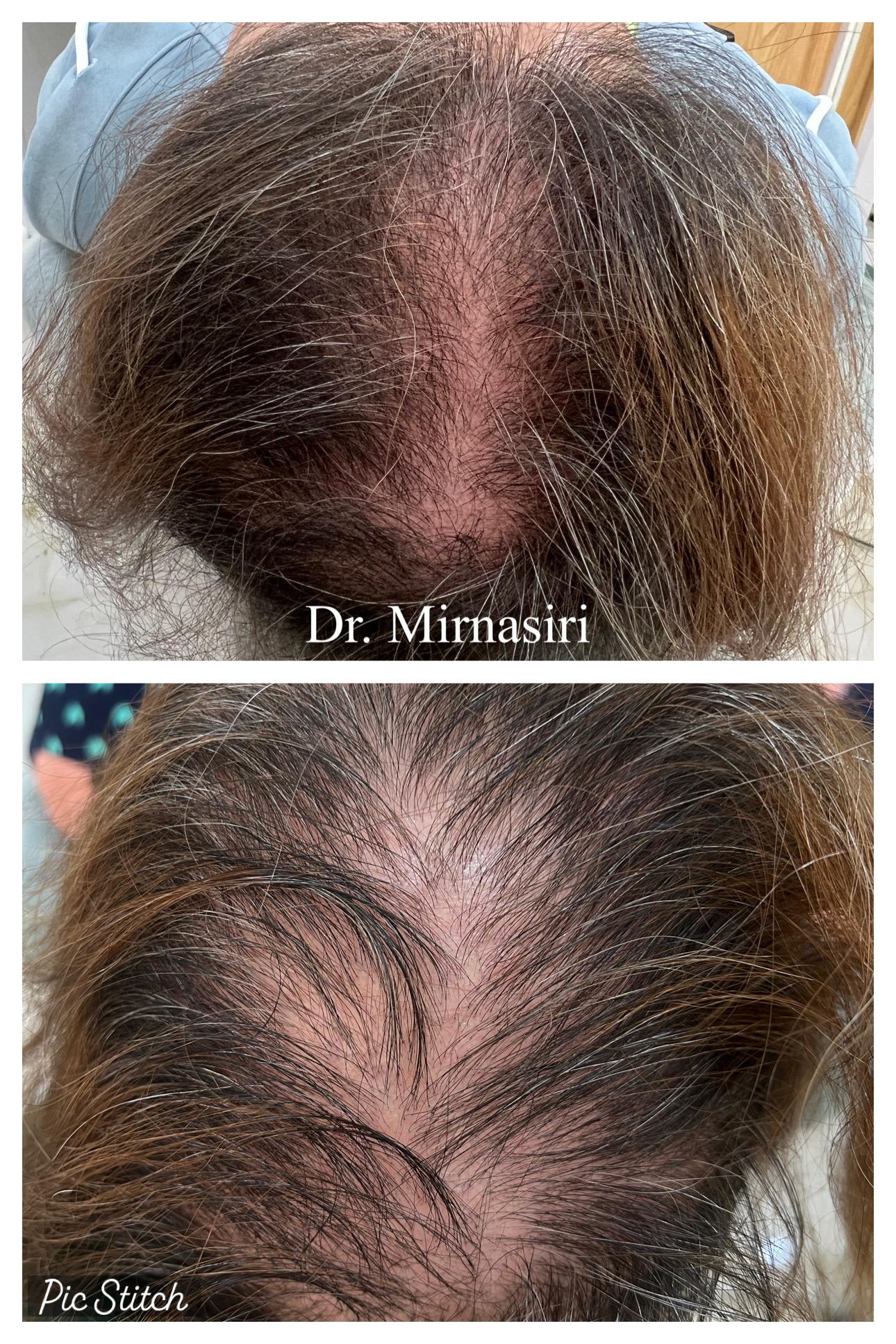 درمان ریزش مو