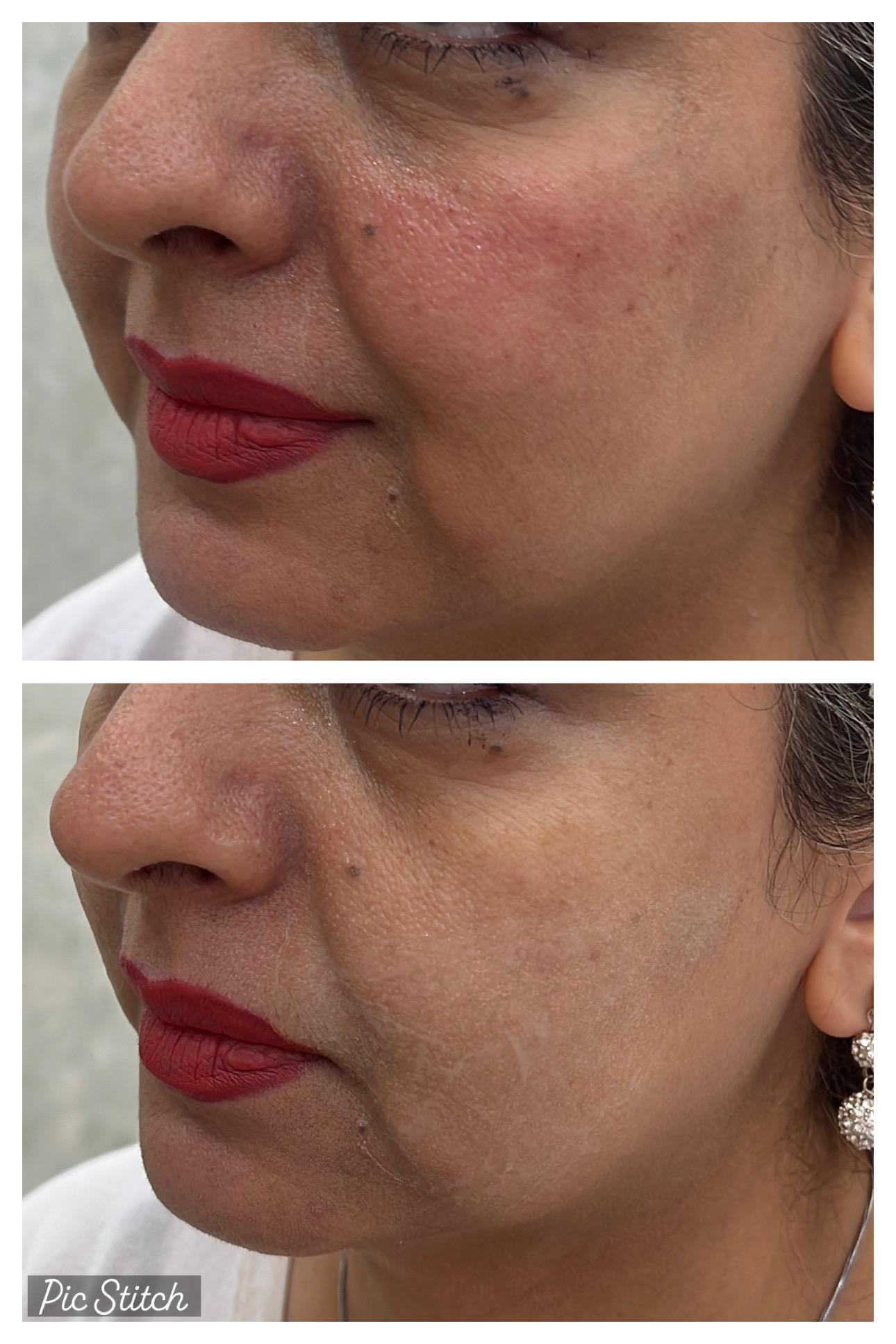 ژل گونه + ژل زیرچشم