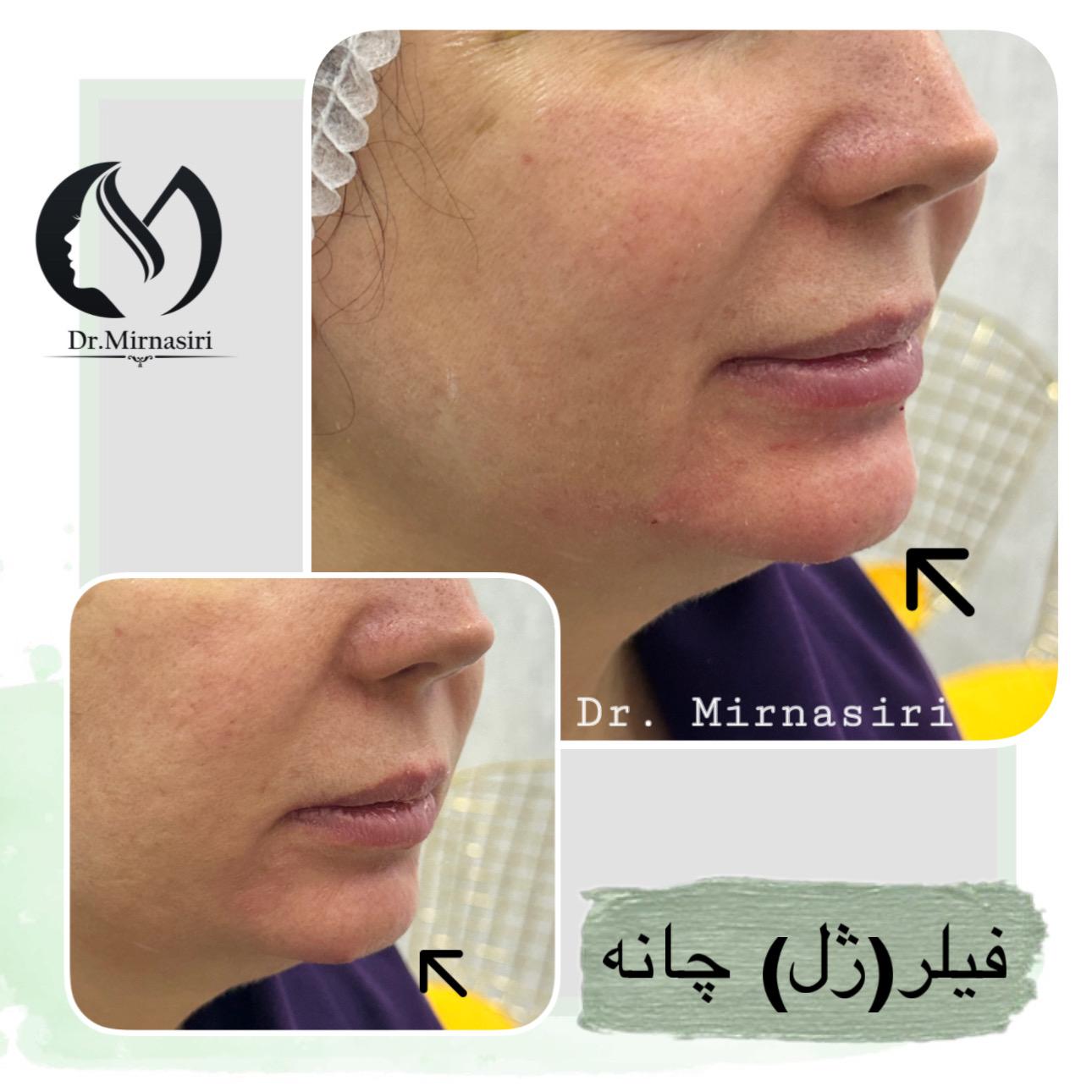 فیلر (ژل) چانه